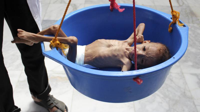 Yemeni child, victim of Saudi war, AFP photo